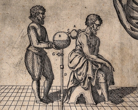 An etching of a doctor and a patient illustrating cupping and bloodletting.